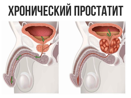 Хронический простатит